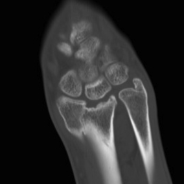 Distal Radial Step OA 2